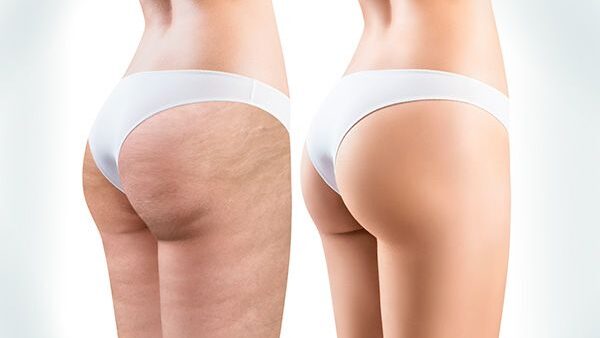 CELULITIS: TRATAMIENTOS CORPORALES PARA ELIMINARLA
