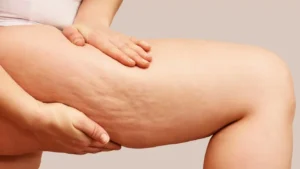 Eliminar la celulitis: Guía de 10 pasos para conseguirlo